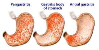 Γαστρίτιδα ή έλκος στομάχου Διαιτολόγος Διατροφολόγος Πάτρα